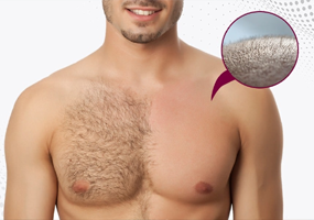 Body Hair Transplant