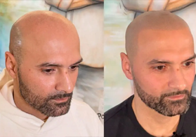 Scalp Micropigmentation